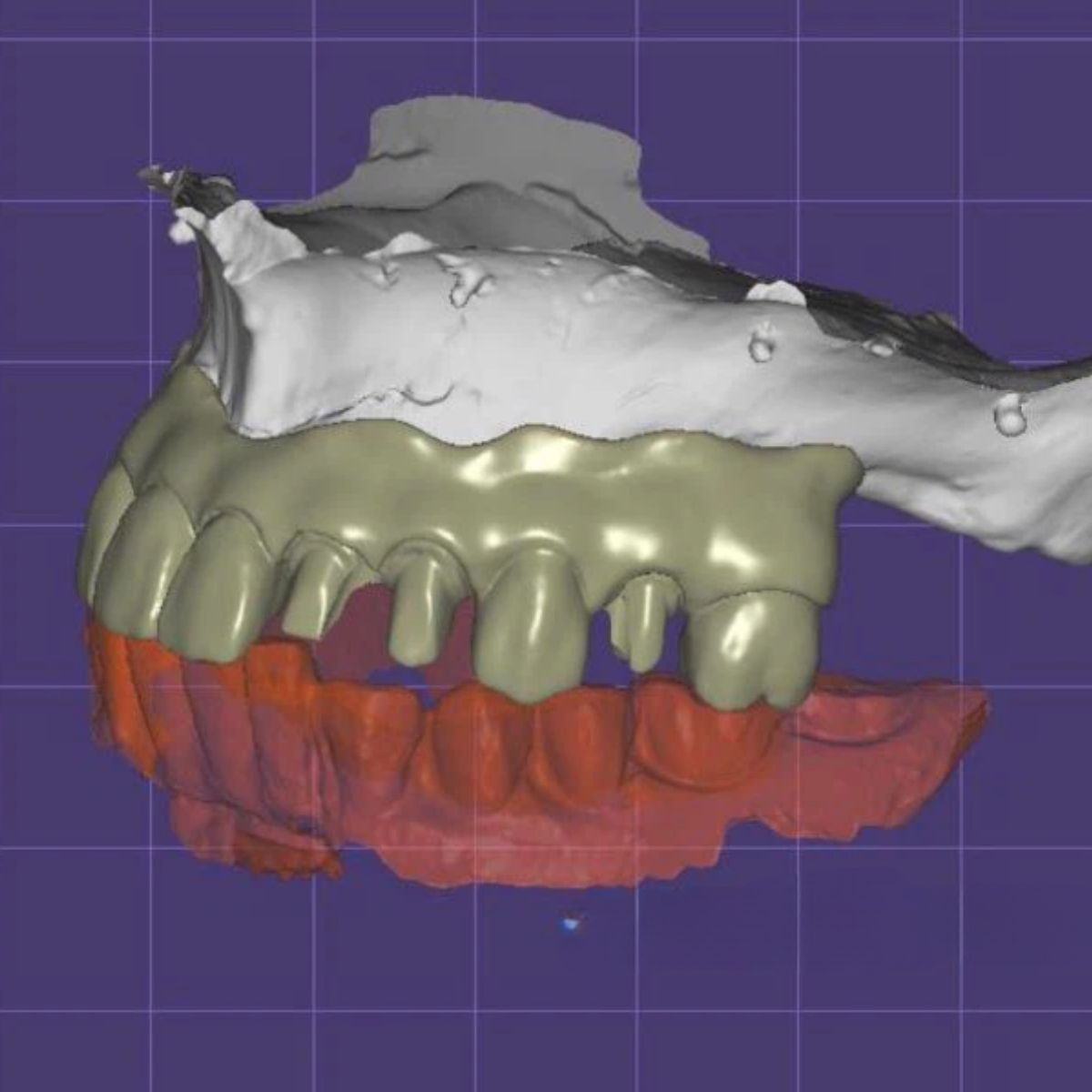 all-on-4-implant-design-cad-service All-on-4 implant design with prosthetic-driven planning CAD/CAM digital file ready for production