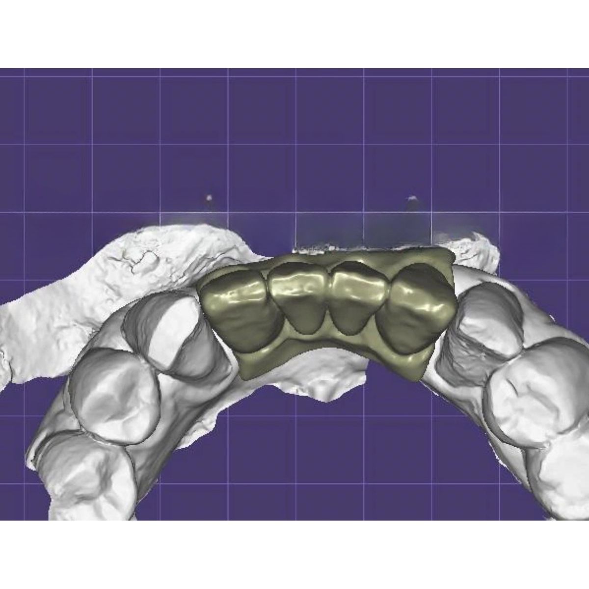 cement-retained-implant-bridge-design-cad Cement retained implant bridge design with custom abutments CAD/CAM digital file ready for production