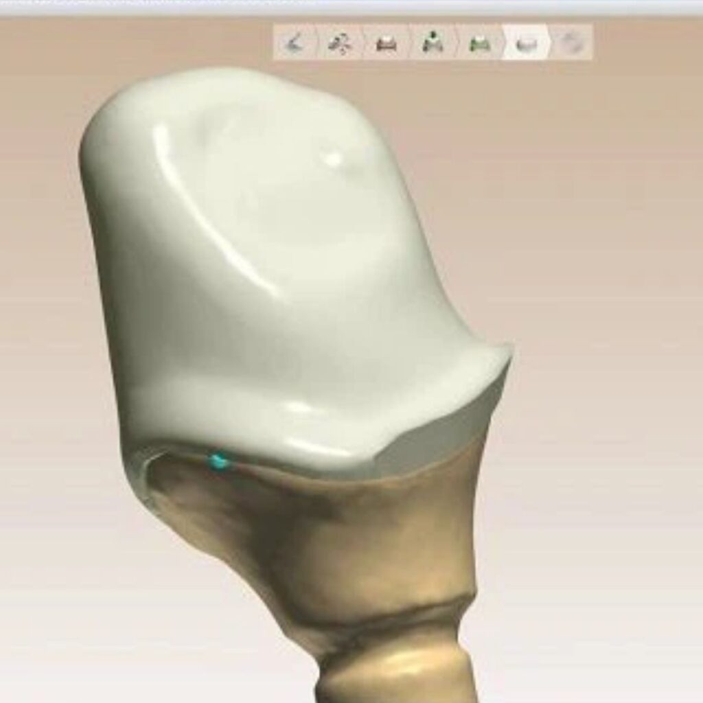 Exocad Crown & Bridge CAD Services | Fast Turnaround