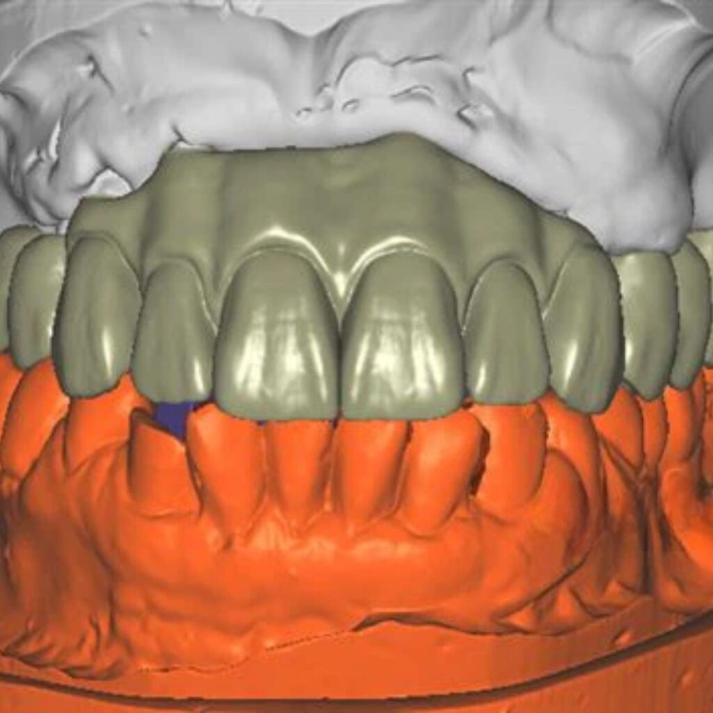 Exocad Crown & Bridge CAD Services | Fast Turnaround