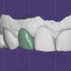 Exocad Crown & Bridge CAD Services | Fast Turnaround
