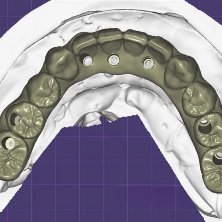 Exocad Crown & Bridge CAD Services | Fast Turnaround