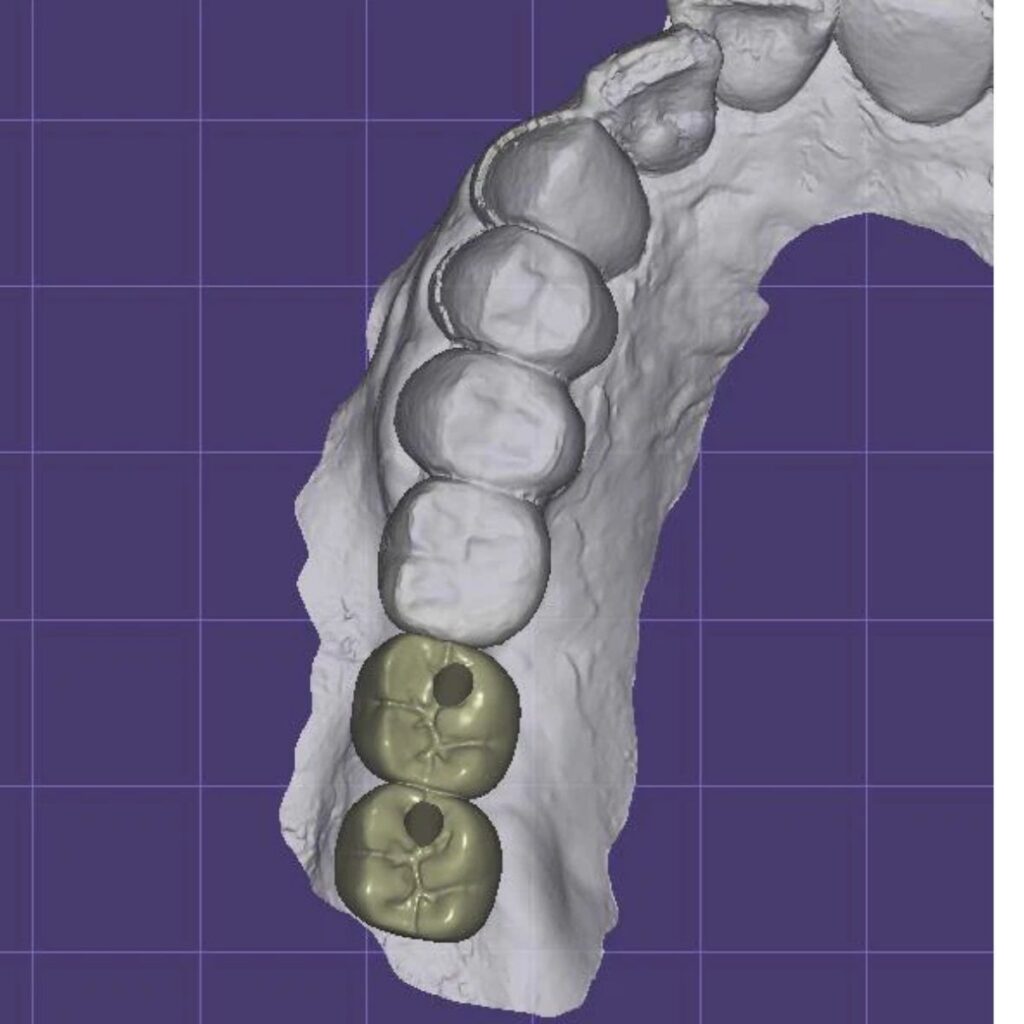 Exocad Crown & Bridge CAD Services | Fast Turnaround