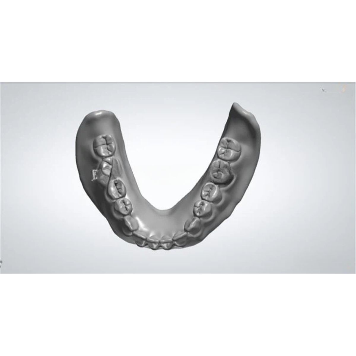 acrylic-denture-design-cad-professional-china-service Professional acrylic denture design CAD workflow showing digital modeling process for full denture fabrication